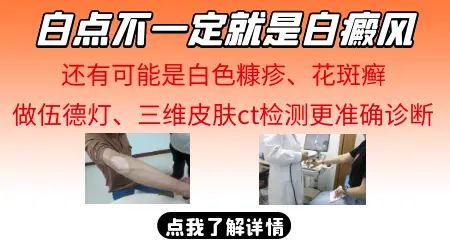 面部白癜风要防范的几类不良诱因